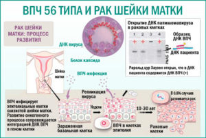 ВПЧ 56 тип и беременность