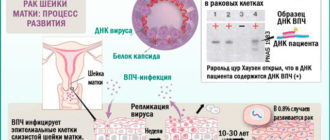 ВПЧ 56 тип и беременность