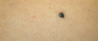 Черная болячка под кожей на спине