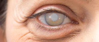 Врожденная катаракта инвалидность