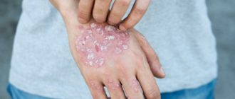 Экзема рук ои ЖКТ