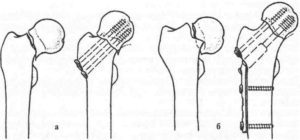 Металлоостеосинтез канюлированными винтами перелома шейки бедра