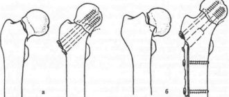 Металлоостеосинтез канюлированными винтами перелома шейки бедра