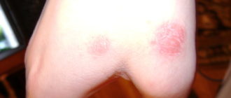 Вылезла болячка на руке очень чешется