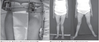 Дисплазия 3 степени через 9 месяцев после родов возможна