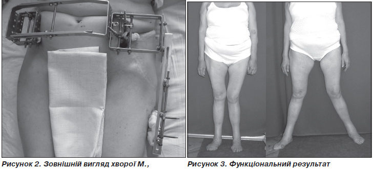 Дисплазия 3 степени через 9 месяцев после родов возможна