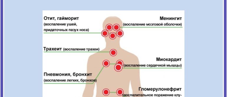 Диабет 2 типа осложнение после гриппа