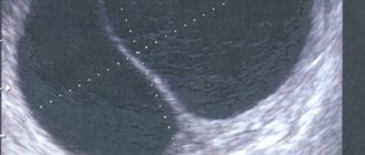 УЗИ: есть жидкость, но нет желтого тела