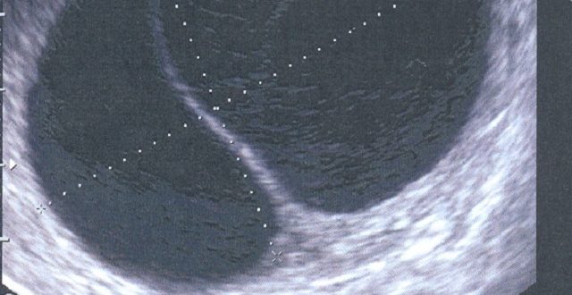 УЗИ: есть жидкость, но нет желтого тела