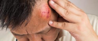 Что делать если, после удара в затылок болит голова?