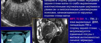 Узи. Выражен сосудистый рисунок и жидкость сзади матки