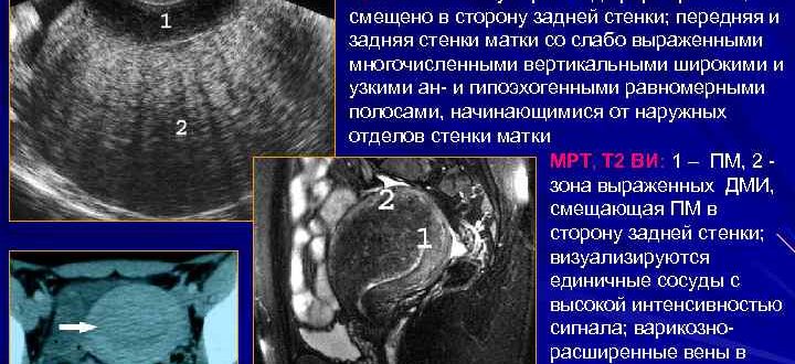 Узи. Выражен сосудистый рисунок и жидкость сзади матки