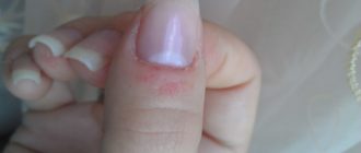 Водяные волдыри под ногтями на подушечках и вокруг ногтя