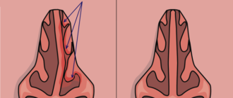 Вазомоторный ринит искривление перегородки