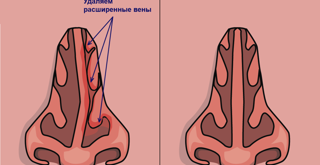 Вазомоторный ринит искривление перегородки