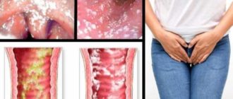 Молочница после защищенного полового акта