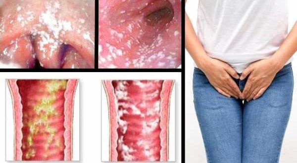 Молочница после защищенного полового акта