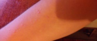 Вылез прыщ на руке, ощущение странные, никак от обычнооо прыщика