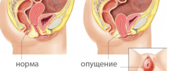 Влагалище стало слишком узким