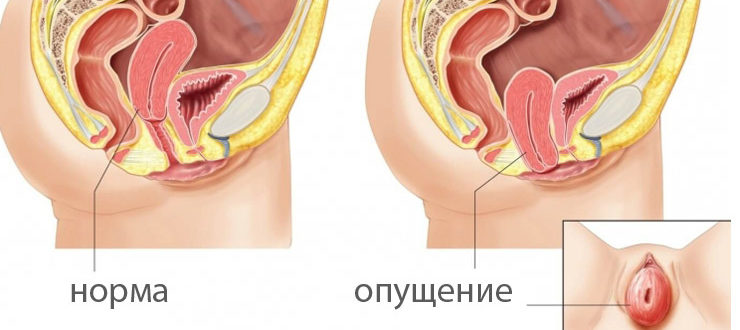 Влагалище стало слишком узким