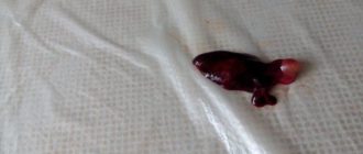 Выкидыш из-за инфекции