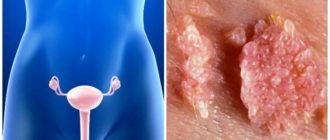 Наросты в виде сосочков во влагалище