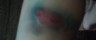 Воспаление пятен после укусов комаров