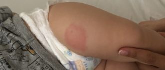 Можем ли мы заразиться коклюшем, если поставлена прививка Пентаксим?