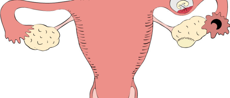 Внематочная беременность