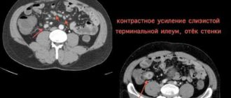 Мезентериальная лимфаденопатия