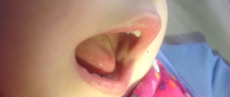 Чёрное пятно на внутренней стороне щеки