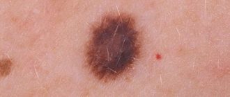 Диспластический смешанный невус