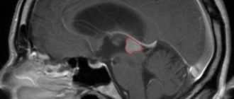 Микроаденома гипофиза и киста шишковидной железы
