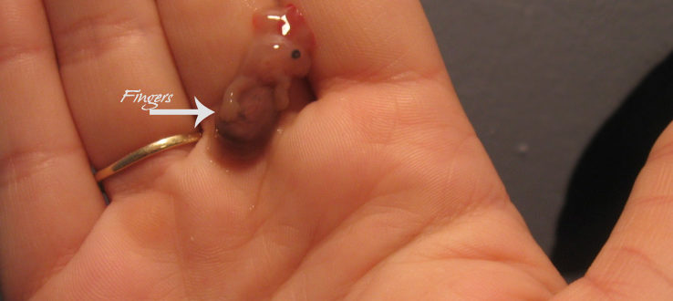 Второй выкидыши подряд