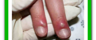 Восполнениям кутикулы у ребёнка на пальце руки