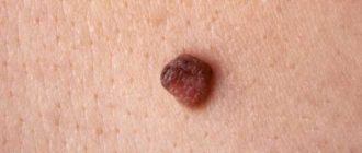 Вопрос об родинке