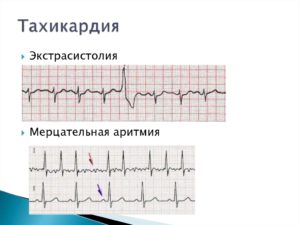 Экстрасистолы и тахикардия