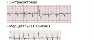 Экстрасистолы и тахикардия