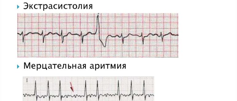 Экстрасистолы и тахикардия