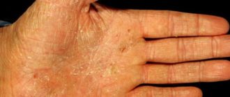 Дисгидроз кистей и стоп