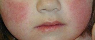 Дерматит, красные пятна