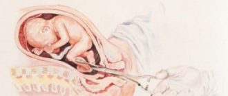 Второй аборт у нерожавшей