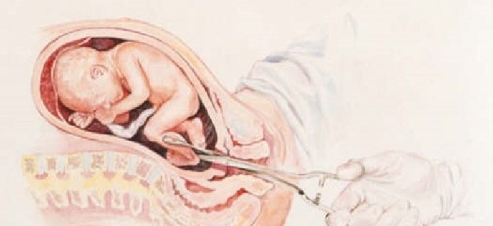 Второй аборт у нерожавшей