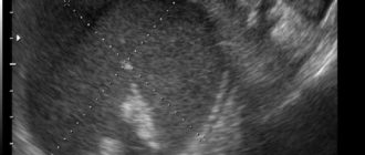 Эндометриоидная киста 25 мм