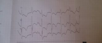 Экг ребенка после ангины