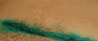 Чем мазать послеоперационный шов