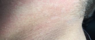 Что за пятна на шее? Зуд, шелушение