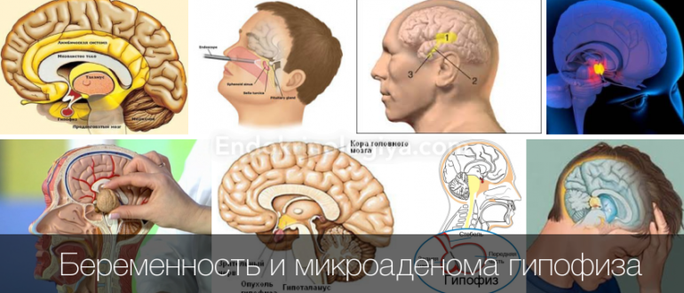 Микроаденома гипофиза при беременности