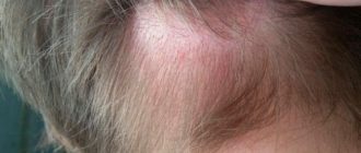 Чешется головка и кожится вокруг