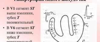 Нарушение процессов реполяризации ЛЖ, ВДСУ